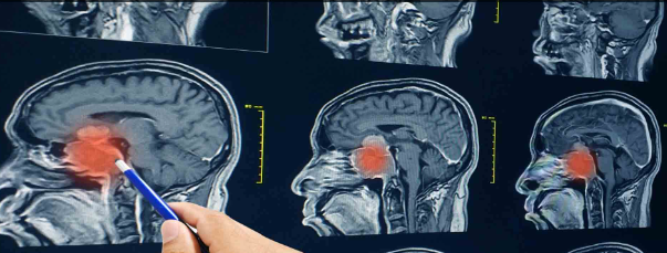 Foto - 'Uluslararası Kanser Dergisi' yazdı! Ölümcül beyin tümörlerine karşı müthiş buluş