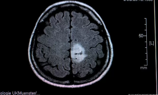 Foto - 'Uluslararası Kanser Dergisi' yazdı! Ölümcül beyin tümörlerine karşı müthiş buluş