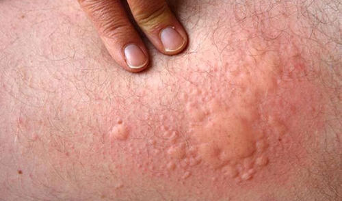 Foto - Ürtiker bahar aylarında artıyor!