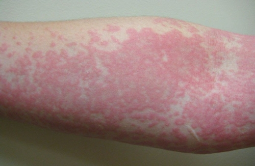 Foto - Ürtiker bahar aylarında artıyor!