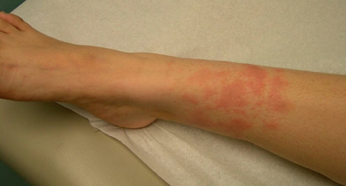 Foto - Ürtiker bahar aylarında artıyor!