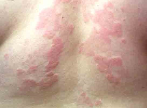 Foto - Ürtiker bahar aylarında artıyor!