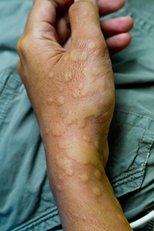 Foto - Ürtiker bahar aylarında artıyor!