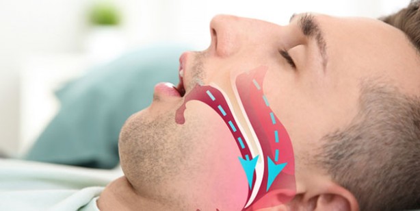 Foto - Uyku apnesi nedir? Uyku apnesi mutlaka tedavi edilmeli