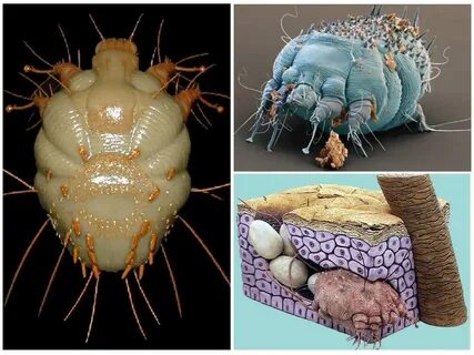 Foto - Uyuz, 15 dakikalık temasla bulaşıyor