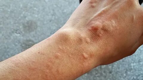 Uyuz, 15 dakikalık temasla bulaşıyor