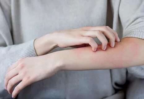 Foto - Uyuz, 15 dakikalık temasla bulaşıyor