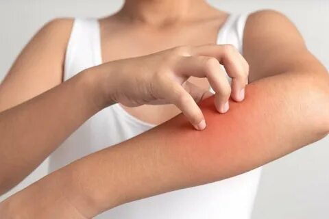 Foto - Uyuz, 15 dakikalık temasla bulaşıyor