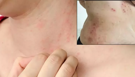 Foto - Uyuz vakaları Türkiye'de arttı, pik yaptı! Kaşıntı gece saati başlıyor! Tek çaresi var, işte uzman mesajı...
