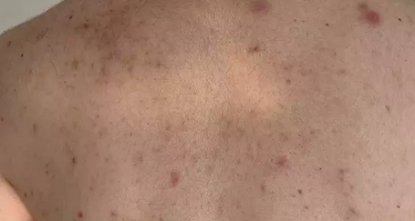 Foto - Uyuz vakaları Türkiye'de arttı, pik yaptı! Kaşıntı gece saati başlıyor! Tek çaresi var, işte uzman mesajı...