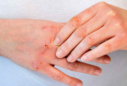 Uyuz vakaları Türkiye'de arttı, pik yaptı! Kaşıntı gece saati başlıyor! Tek çaresi var, işte uzman mesajı...