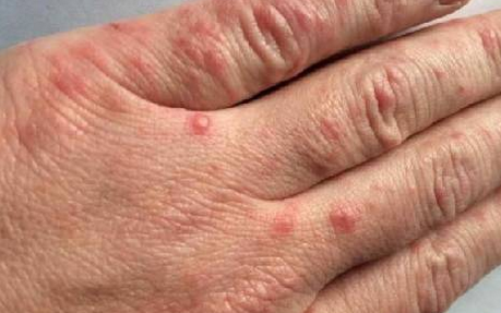 Foto - Uyuz vakaları Türkiye'de arttı, pik yaptı! Kaşıntı gece saati başlıyor! Tek çaresi var, işte uzman mesajı...