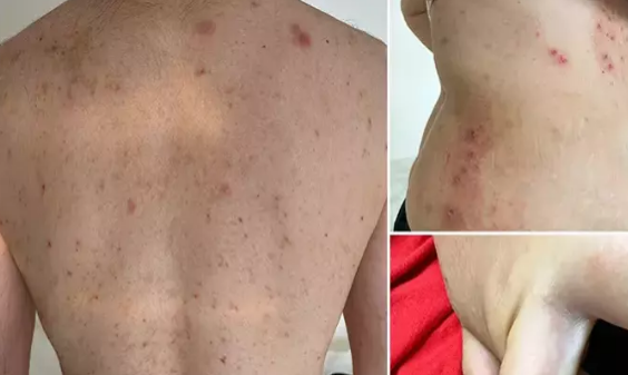 Foto - Uyuz vakaları Türkiye'de arttı, pik yaptı! Kaşıntı gece saati başlıyor! Tek çaresi var, işte uzman mesajı...