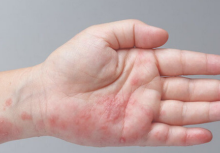 Foto - Uyuz vakaları Türkiye'de arttı, pik yaptı! Kaşıntı gece saati başlıyor! Tek çaresi var, işte uzman mesajı...