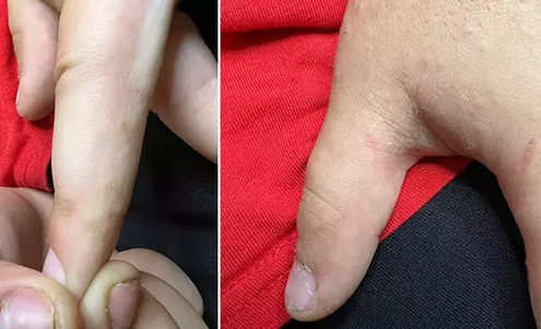 Foto - Uyuz vakaları Türkiye'de arttı, pik yaptı! Kaşıntı gece saati başlıyor! Tek çaresi var, işte uzman mesajı...