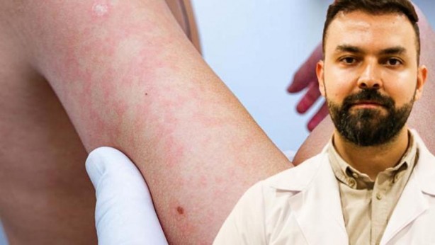 Uyuz vakaları yüzde 30 arttı, bazı kremlere direnç göstermeye başladı! Uyuz nasıl geçer? Sirke veya sirkeli su işe yarıyor mu? Dermatoloji Uzmanı açıkladı