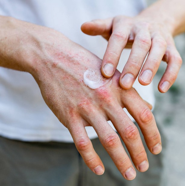 Foto - Uzman doktor üstüne basa basa uyardı! Alerjen madde ve stres egzamayı tetikliyor!