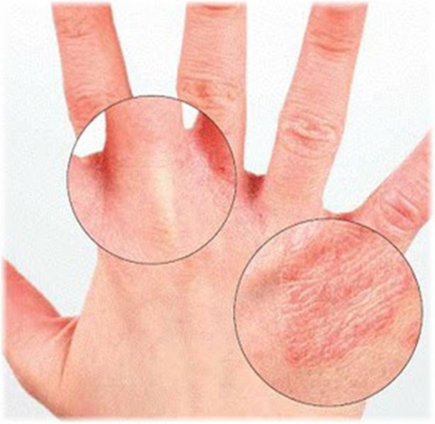 Foto - Uzman doktor üstüne basa basa uyardı! Alerjen madde ve stres egzamayı tetikliyor!