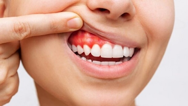 Foto - Uzman doktor uyardı! Dişinizde bu varsa felç olabilirsiniz