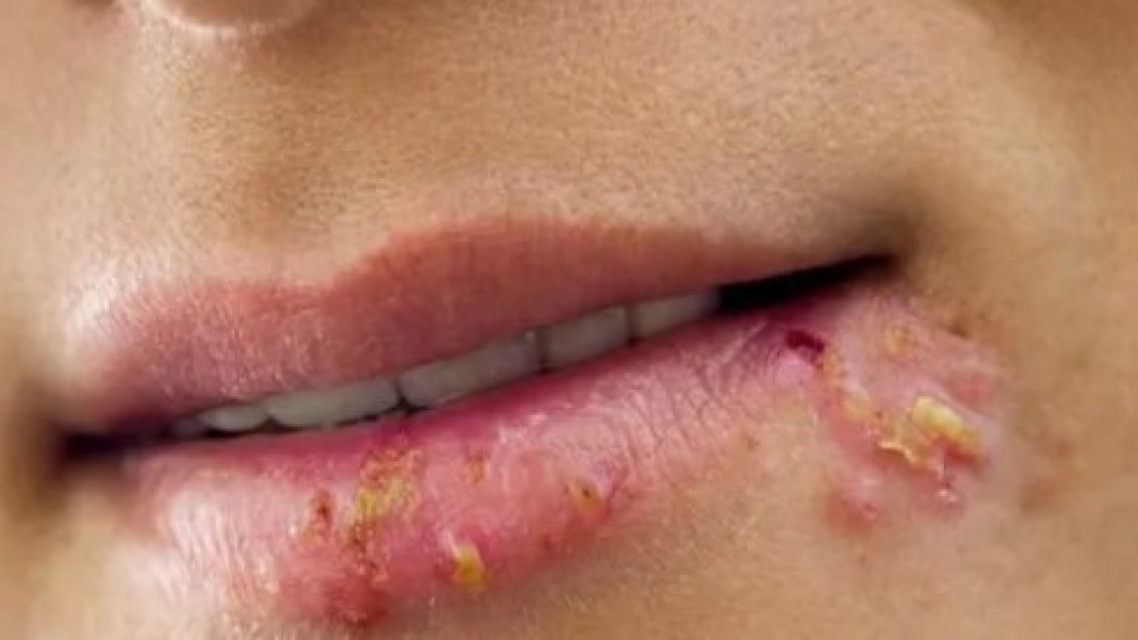 Foto - Uzman isim uyardı: Dudaklardaki bu değişime dikkat!