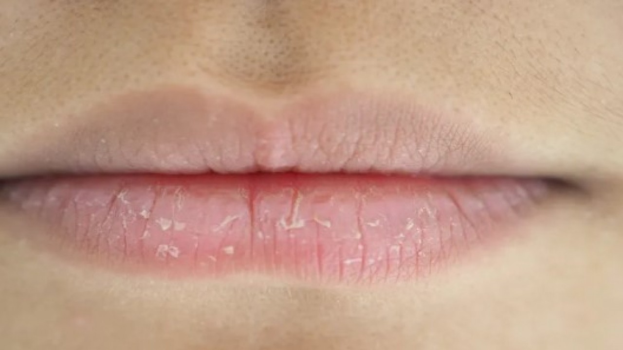 Foto - Uzman isim uyardı: Dudaklardaki bu değişime dikkat!