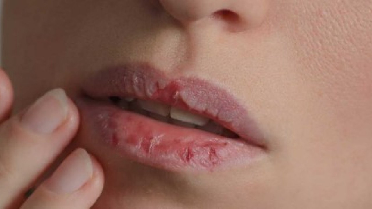 Foto - Uzman isim uyardı: Dudaklardaki bu değişime dikkat!