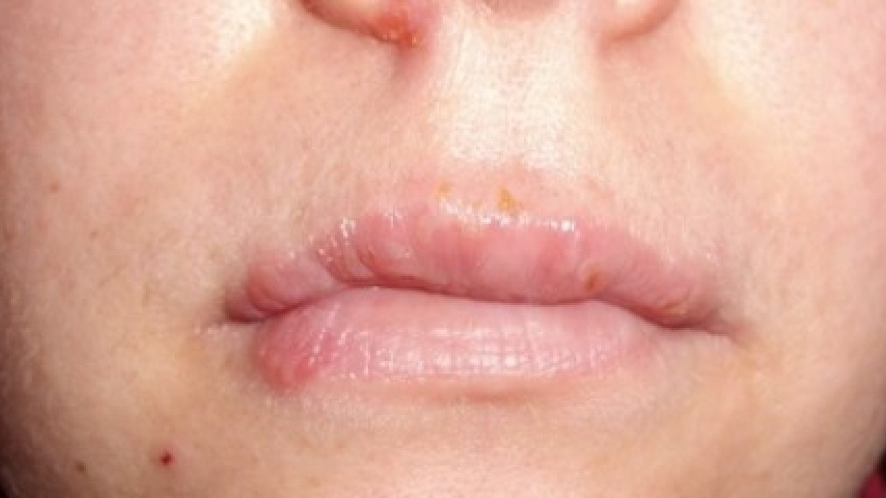 Foto - Uzman isim uyardı: Dudaklardaki bu değişime dikkat!