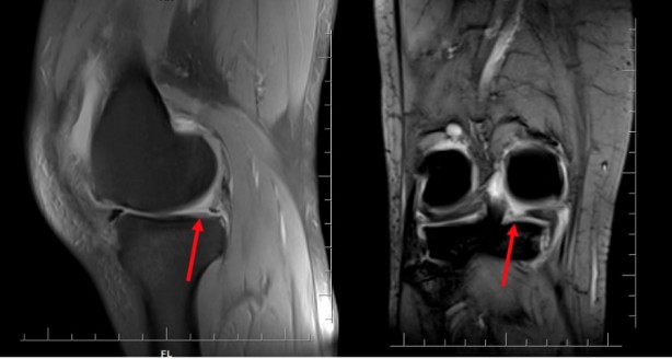 Foto - Uzman isim uyardı: Menisküs yırtığına dikkat!