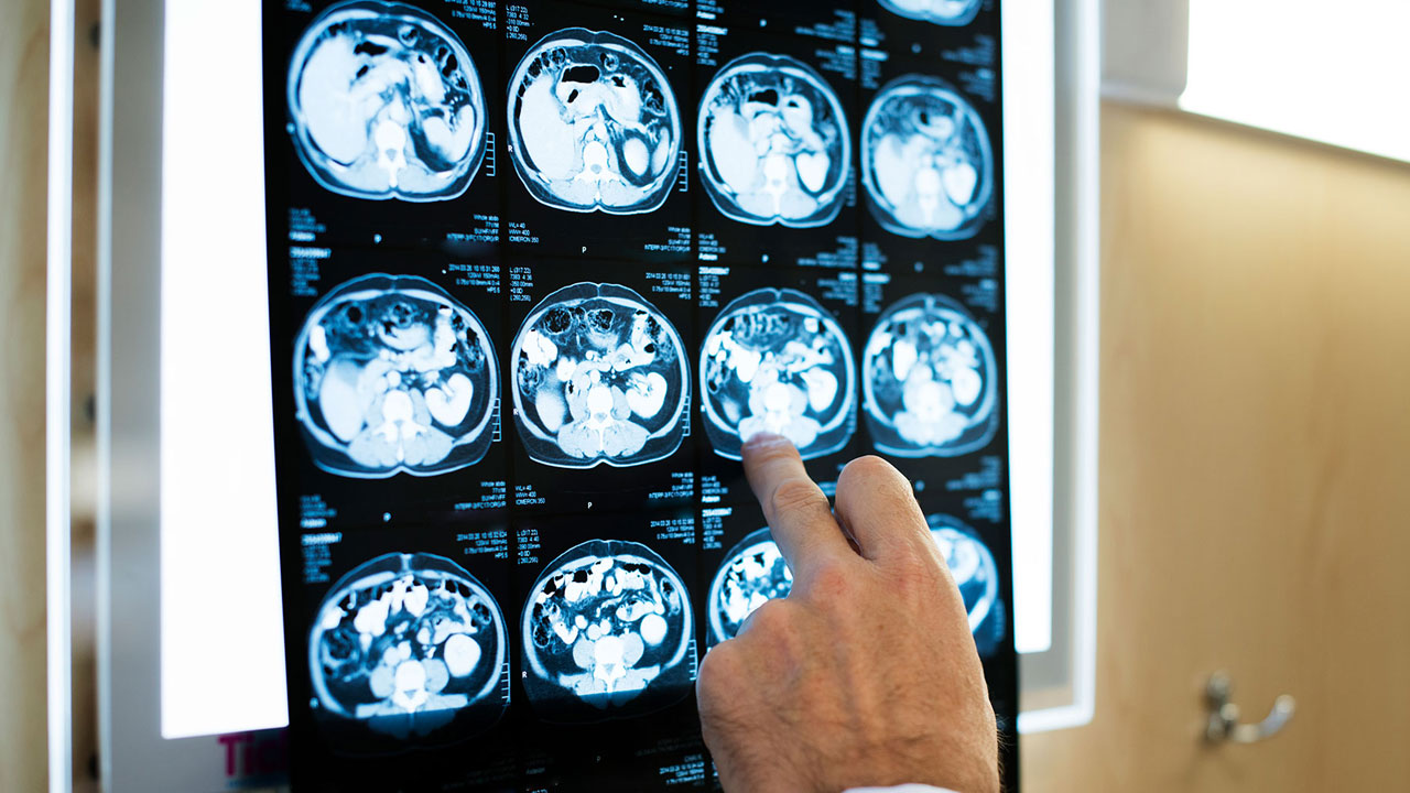 Uzman isimden korkutan açıklama! Bu hastalık gençler arasında yaygınlaşmaya başladı