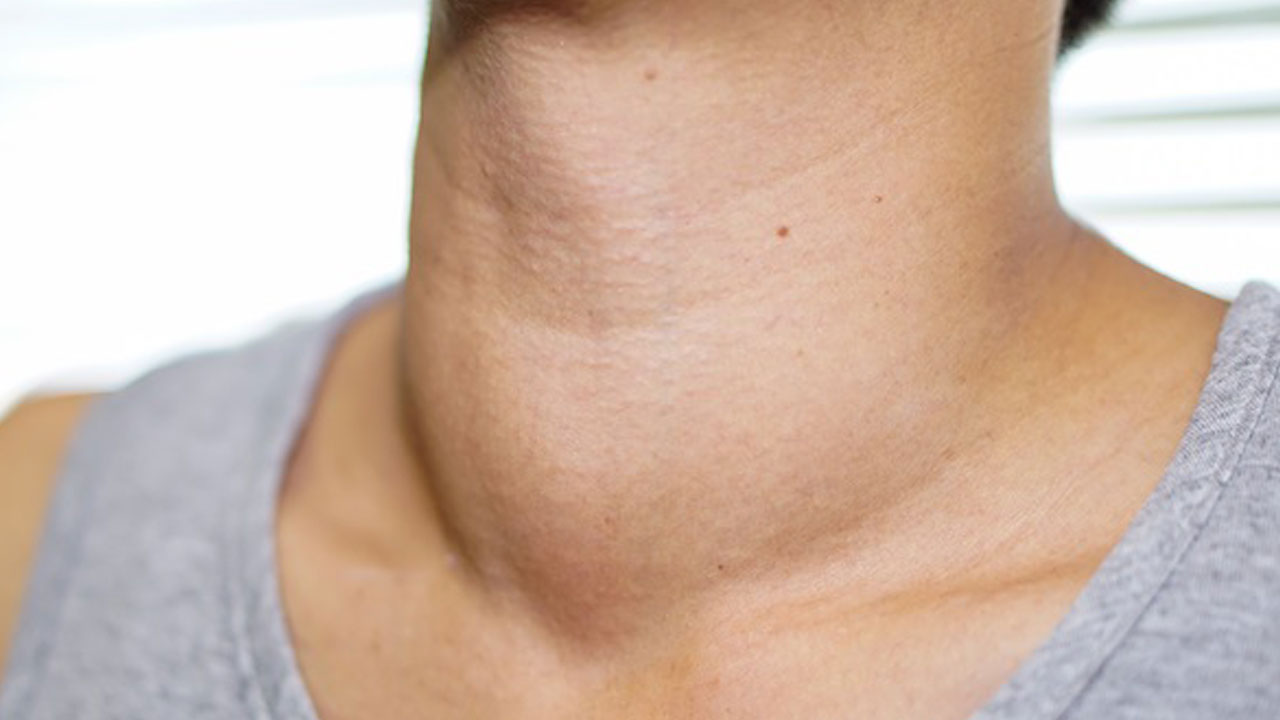Foto - Uzman isimden kritik açıklama! Boynunuzda böyle bir şişlik varsa hemen doktora başvurun