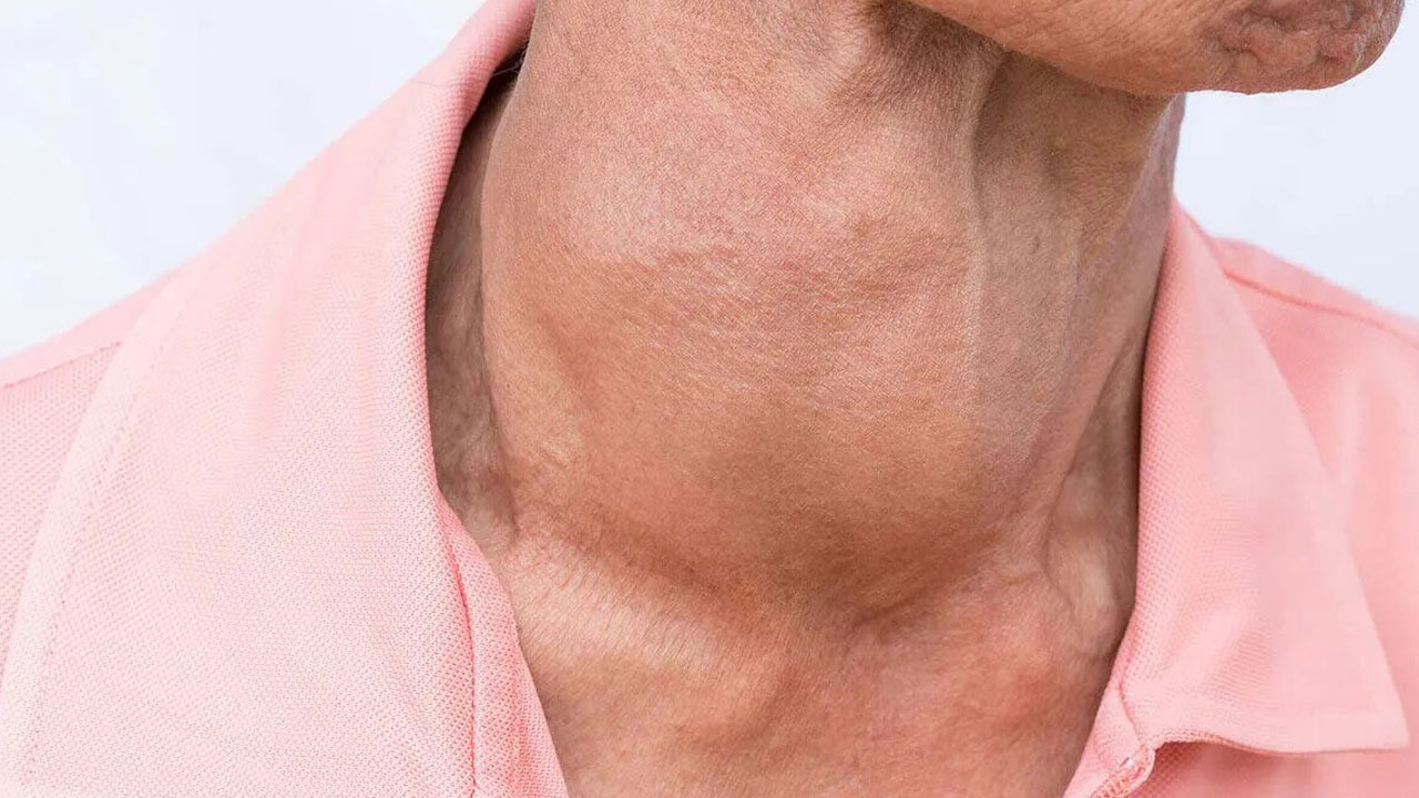 Uzman isimden kritik açıklama! Boynunuzda böyle bir şişlik varsa hemen doktora başvurun