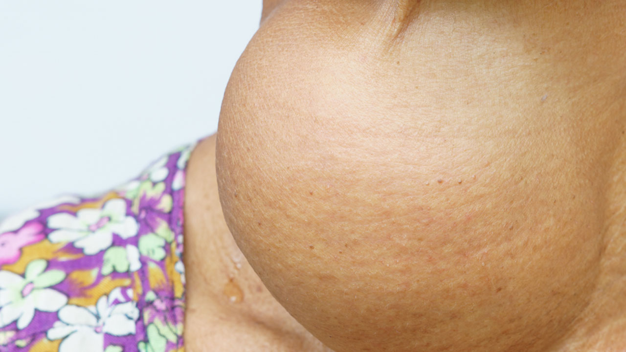 Foto - Uzman isimden kritik açıklama! Boynunuzda böyle bir şişlik varsa hemen doktora başvurun