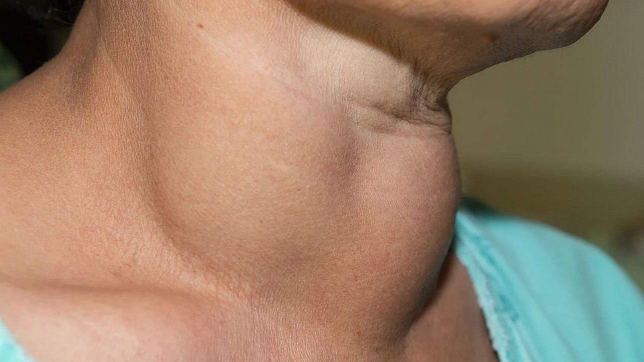 Foto - Uzman isimden kritik açıklama! Boynunuzda böyle bir şişlik varsa hemen doktora başvurun