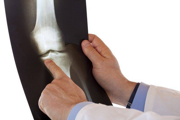 Foto - Uzman isimden önemli tavsiyeler! Bu yöntemle kemik erimesine 'dur' deyin