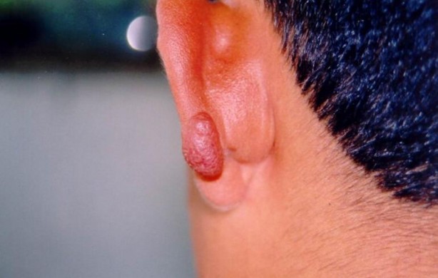 Foto - Uzman isimden sivri ve sinek uyarısı! Vücudunuzda yara çıkıyorsa…