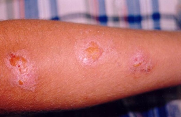 Foto - Uzman isimden sivri ve sinek uyarısı! Vücudunuzda yara çıkıyorsa…