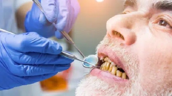 Foto - Uzmanı bilgi verdi! Bu işlemle saniyeler içinde dişleriniz beyazlıyor