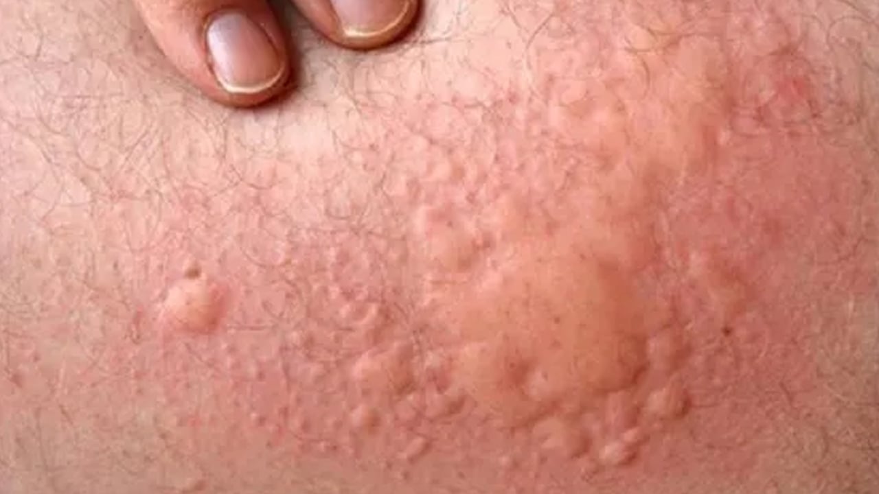 Uzmanı mesajı verdi: Besini tüketirken çözüm değil aksine bu hata kısa süre el ve ayaklarda şişmeye neden oluyor