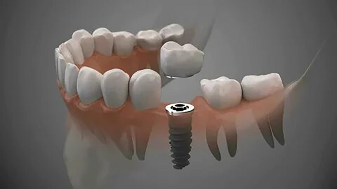 Foto - Uzmanından implant uyarısı! Sağlam dişlerinizi riske atmayın!