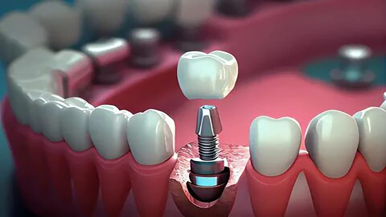 Foto - Uzmanından implant uyarısı! Sağlam dişlerinizi riske atmayın!