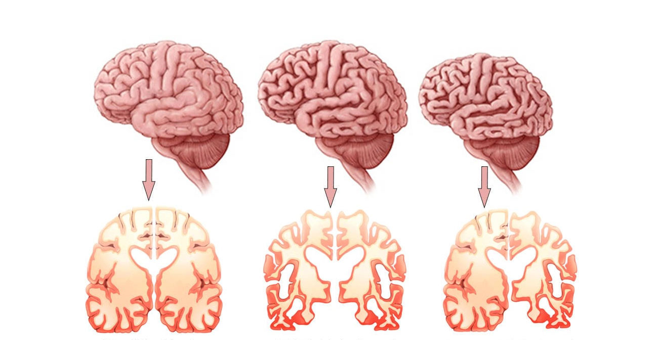 Foto - Alzheimer kader değil, erken farkındalıkla önlenebilir!
