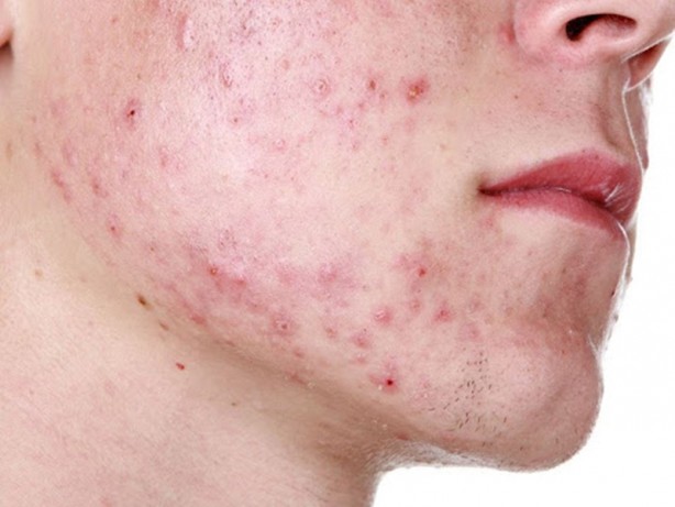 Foto - Uzmanlar açıkladı! Kanser hücrelerini öldürüyor...