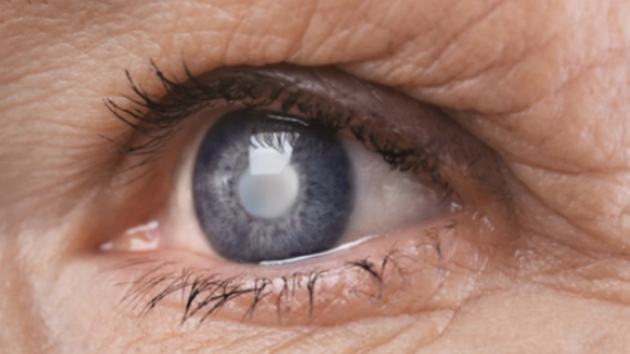 Uzmanlar açıkladı! Katarakt nasıl tedavi edilir?