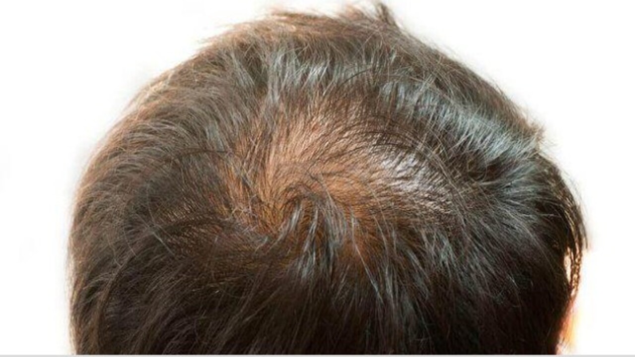 Foto - Uzmanlar açıkladı! Saçlarda seyreklik neden olur?