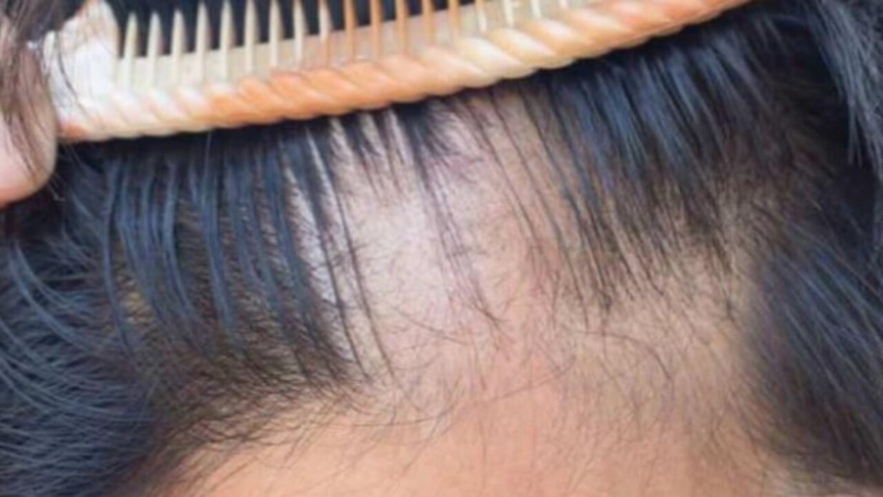 Foto - Uzmanlar açıkladı! Saçlarda seyreklik neden olur?