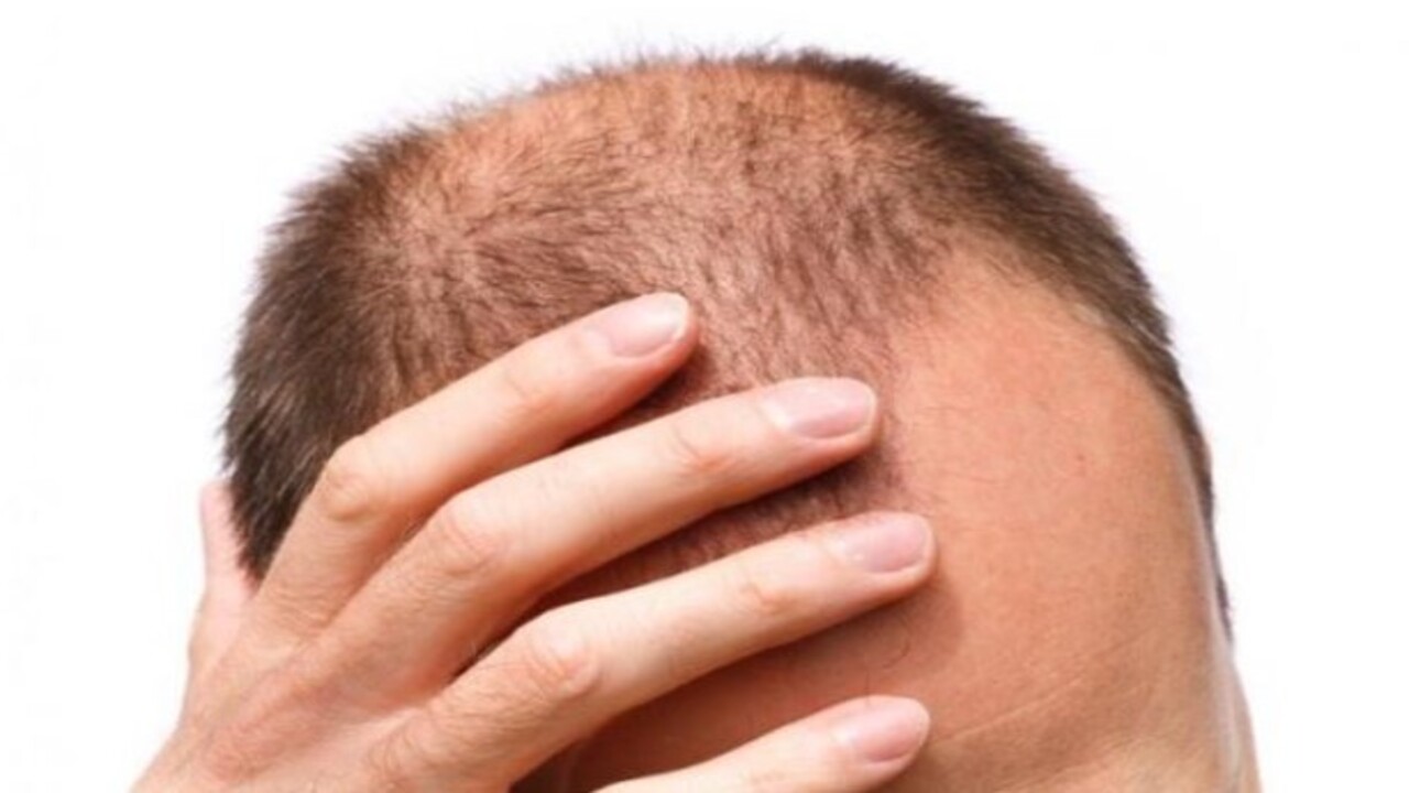 Foto - Uzmanlar açıkladı! Saçlarda seyreklik neden olur?