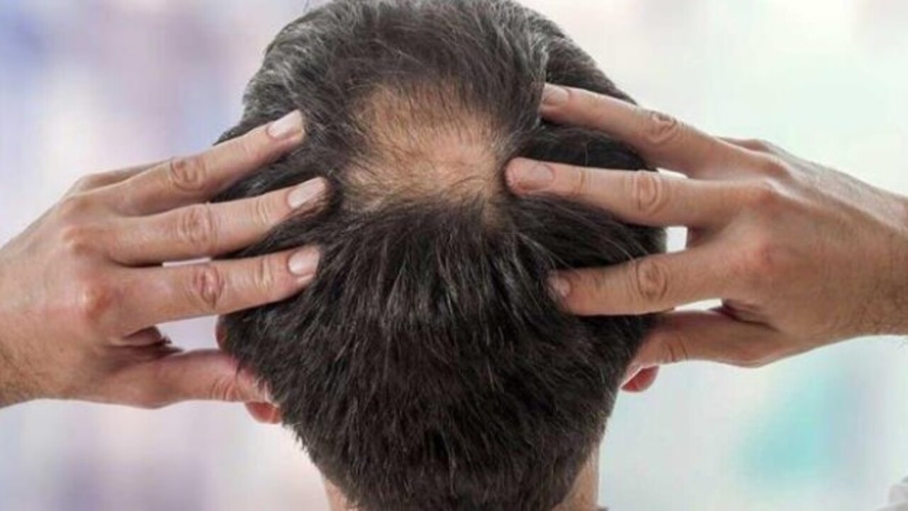 Uzmanlar açıkladı! Saçlarda seyreklik neden olur?