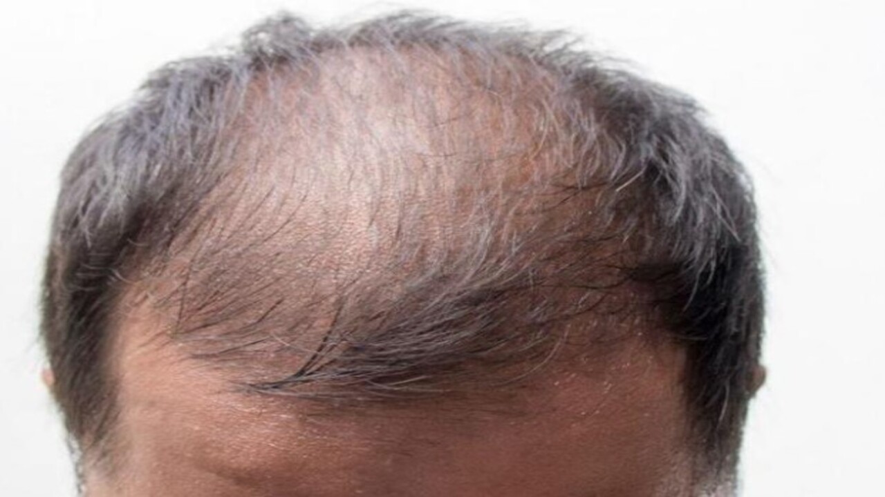 Foto - Uzmanlar açıkladı! Saçlarda seyreklik neden olur?