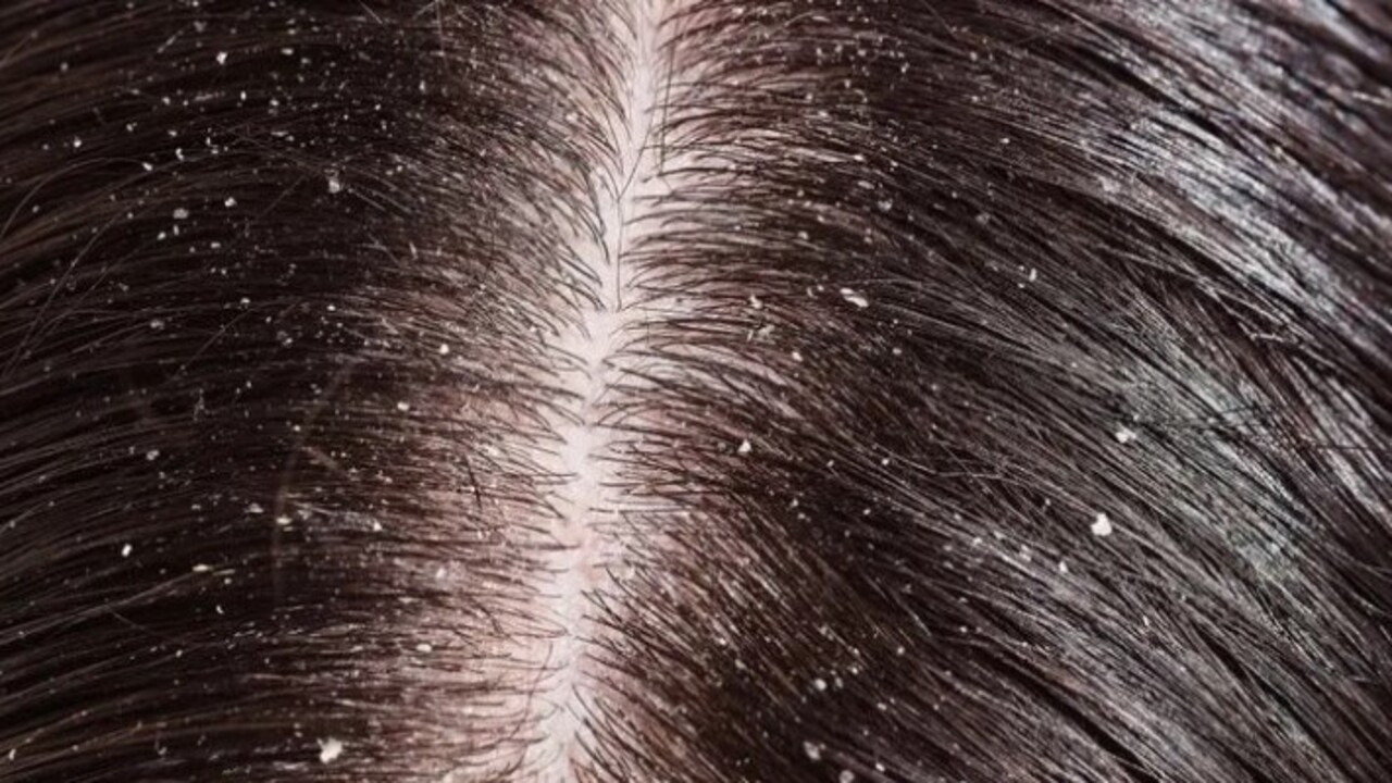 Uzmanlar açıkladı! Saçları kepekten arındıran doğal yöntem bulundu