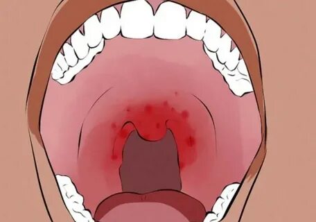 Uzmanlar ağız kanseri için dikkat edilmesi gereken belirtileri açıkladı